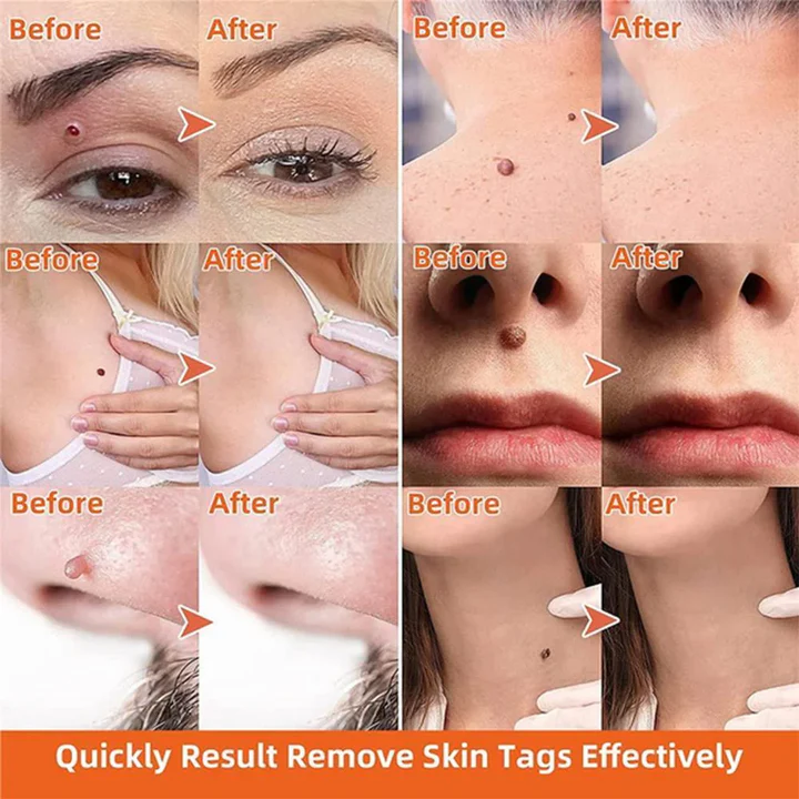 Easy Skin Tag Remover for Men and Women
