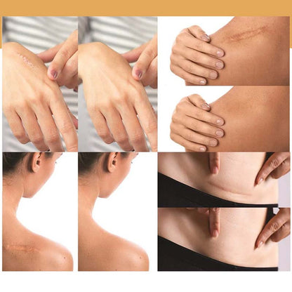 Clear Skin Concealer Sticker Patch