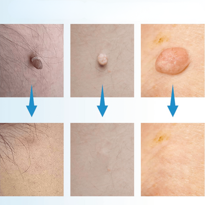 Fast Wart Removal Cream