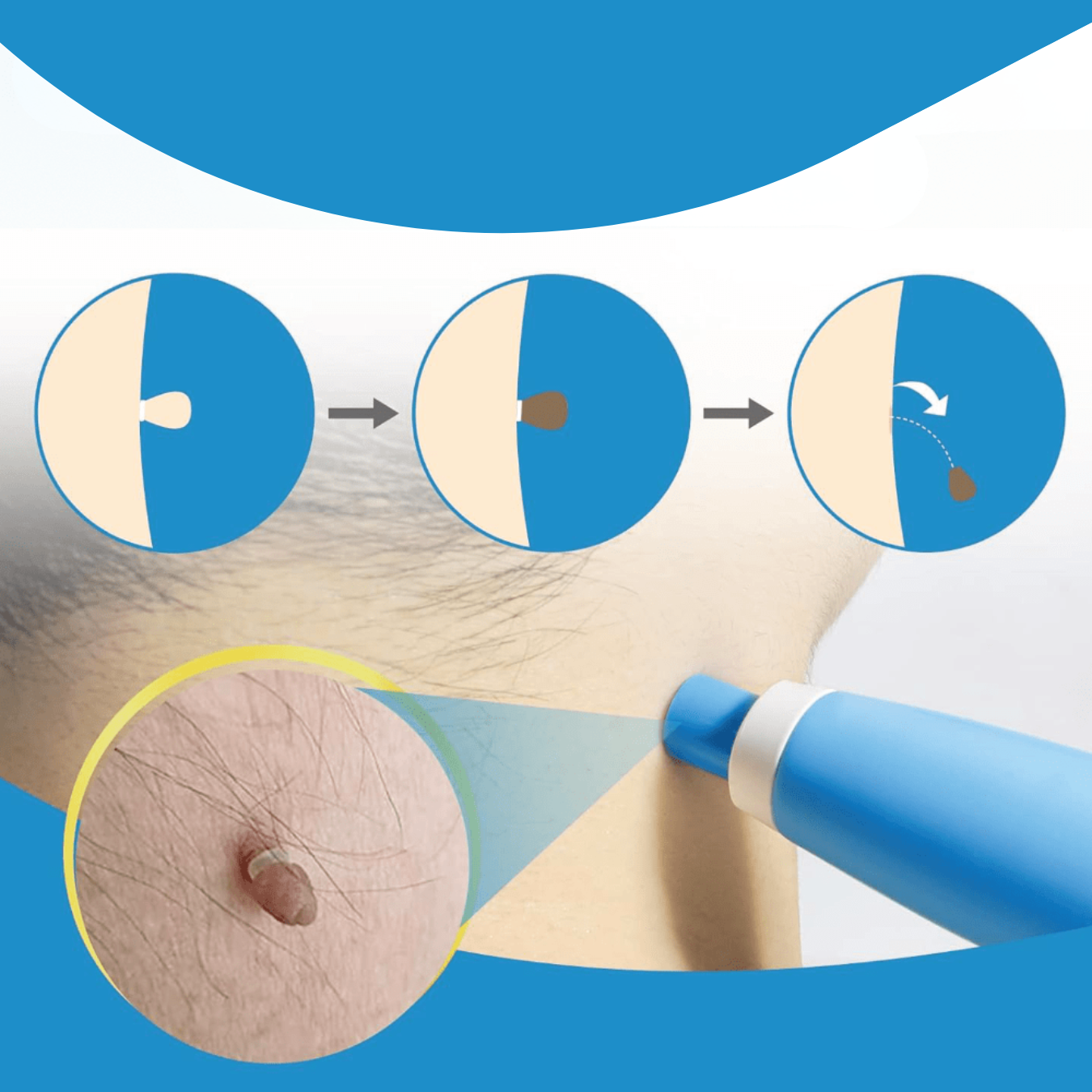 Fast Wart Removal Cream