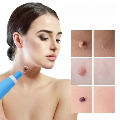 Fast Wart Removal Cream - Yeezlab